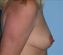 Breast Augmentation Before Photo by Daniel Mills, MD; Laguna Beach, CA - Case 24640
