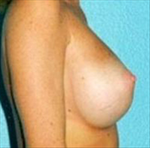 Breast Augmentation After Photo by Daniel Mills, MD; Laguna Beach, CA - Case 24657