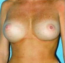 Breast Augmentation After Photo by Daniel Mills, MD; Laguna Beach, CA - Case 24657