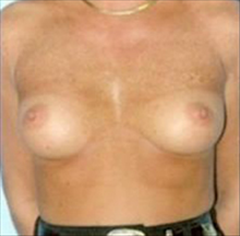 Breast Augmentation Before Photo by Daniel Mills, MD; Laguna Beach, CA - Case 24657