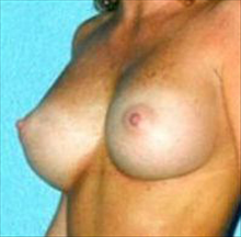 Breast Augmentation After Photo by Daniel Mills, MD; Laguna Beach, CA - Case 24657