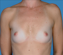 Breast Augmentation Before Photo by Daniel Mills, MD; ,  - Case 24660