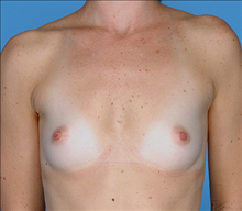 Breast Augmentation Before Photo by Daniel Mills, MD; ,  - Case 24663