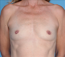 Breast Augmentation Before Photo by Daniel Mills, MD; Laguna Beach, CA - Case 24664