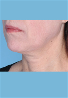 Facelift After Photo by Daniel Mills, MD; Laguna Beach, CA - Case 24666