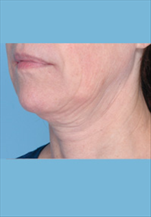 Facelift Before Photo by Daniel Mills, MD; Laguna Beach, CA - Case 24666