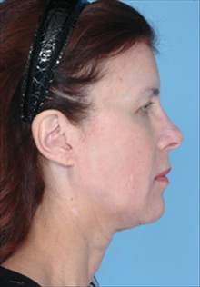 Facelift After Photo by Daniel Mills, MD; Laguna Beach, CA - Case 24666