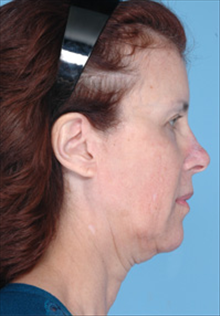 Facelift Before Photo by Daniel Mills, MD; Laguna Beach, CA - Case 24666