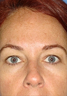 Facelift After Photo by Daniel Mills, MD; Laguna Beach, CA - Case 24668
