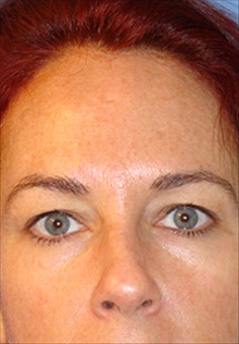 Facelift Before Photo by Daniel Mills, MD; Laguna Beach, CA - Case 24668