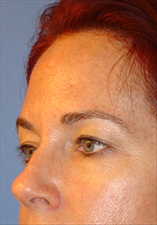 Facelift After Photo by Daniel Mills, MD; Laguna Beach, CA - Case 24668