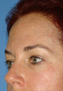 Facelift Before Photo by Daniel Mills, MD; Laguna Beach, CA - Case 24668