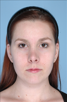 Rhinoplasty After Photo by Daniel Mills, MD; Laguna Beach, CA - Case 24724