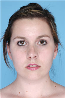 Rhinoplasty Before Photo by Daniel Mills, MD; Laguna Beach, CA - Case 24724