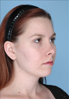 Rhinoplasty After Photo by Daniel Mills, MD; Laguna Beach, CA - Case 24724