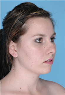 Rhinoplasty Before Photo by Daniel Mills, MD; Laguna Beach, CA - Case 24724