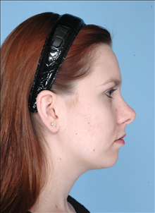 Rhinoplasty After Photo by Daniel Mills, MD; Laguna Beach, CA - Case 24724