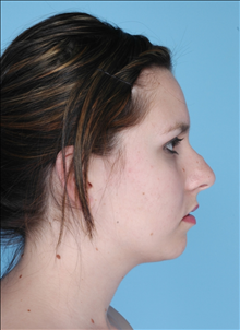 Rhinoplasty Before Photo by Daniel Mills, MD; Laguna Beach, CA - Case 24724
