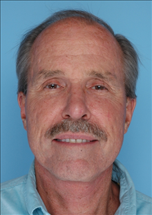 Facelift After Photo by Daniel Mills, MD; ,  - Case 24726