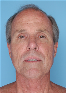 Facelift Before Photo by Daniel Mills, MD; ,  - Case 24726