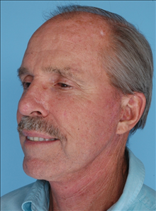 Facelift After Photo by Daniel Mills, MD; ,  - Case 24726
