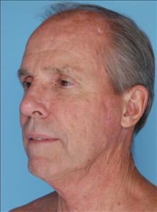 Facelift Before Photo by Daniel Mills, MD; ,  - Case 24726