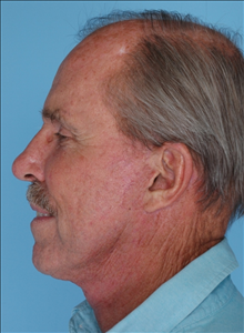 Facelift After Photo by Daniel Mills, MD; ,  - Case 24726