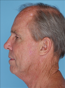 Facelift Before Photo by Daniel Mills, MD; ,  - Case 24726