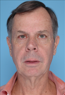 Facelift Before Photo by Daniel Mills, MD; Laguna Beach, CA - Case 24727