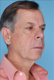 Facelift Before Photo by Daniel Mills, MD; Laguna Beach, CA - Case 24727