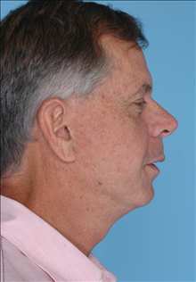 Facelift After Photo by Daniel Mills, MD; Laguna Beach, CA - Case 24727