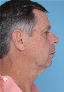 Facelift Before Photo by Daniel Mills, MD; Laguna Beach, CA - Case 24727