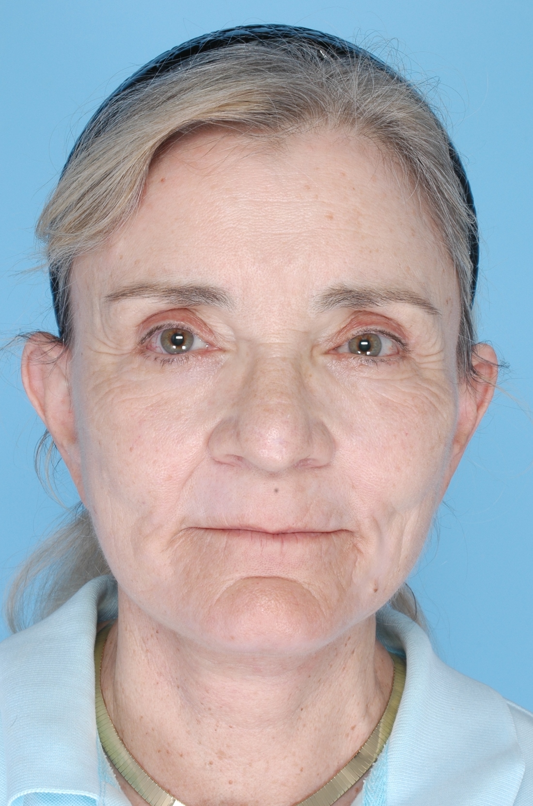 Facelift Before and After Photos by Daniel Mills, MD