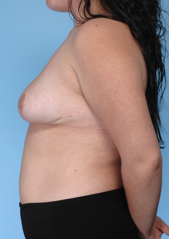 Breast Reduction Before and After Pictures Case 11289