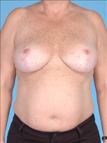 Breast Reduction After Photo by Daniel Mills, MD; Laguna Beach, CA - Case 24732