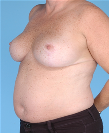 Breast Reduction After Photo by Daniel Mills, MD; Laguna Beach, CA - Case 24732