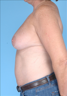 Breast Reduction Before Photo by Daniel Mills, MD; Laguna Beach, CA - Case 24732