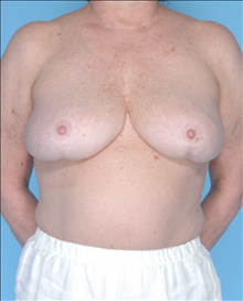 Breast Reduction After Photo by Daniel Mills, MD; Laguna Beach, CA - Case 24733