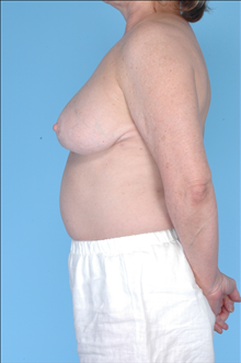 Breast Reduction After Photo by Daniel Mills, MD; Laguna Beach, CA - Case 24733