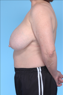 Breast Reduction Before Photo by Daniel Mills, MD; Laguna Beach, CA - Case 24733