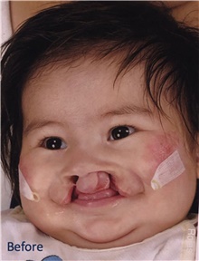 Cleft Lip and Palate Repair Before Photo by James Bradley, MD, FACS; ,  - Case 46753