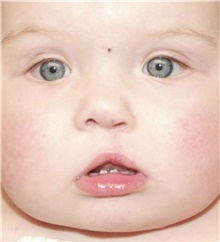 Cleft Lip and Palate Repair After Photo by James Bradley, MD, FACS; Lake Success, NY - Case 46755
