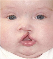 Cleft Lip and Palate Repair Before Photo by James Bradley, MD, FACS; Lake Success, NY - Case 46755