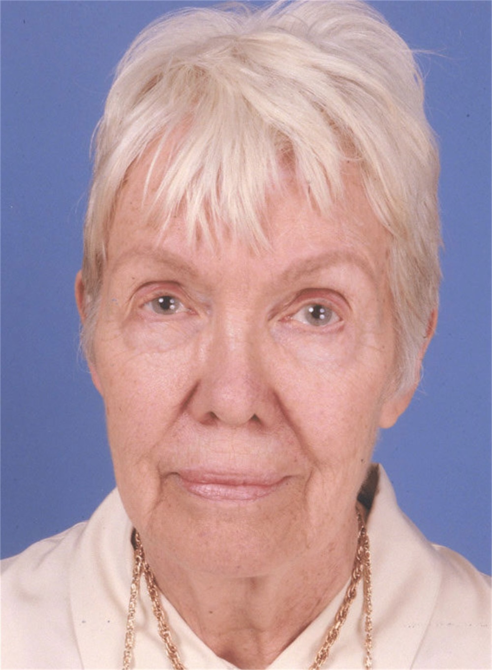 Facelift Before and After Photos by James Bradley, MD, FACS; Lake