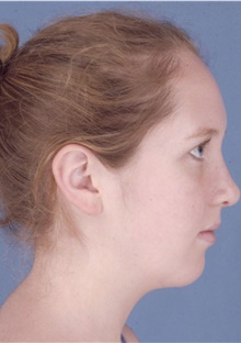 Rhinoplasty After Photo by James Bradley, MD, FACS; Lake Success, NY - Case 46759