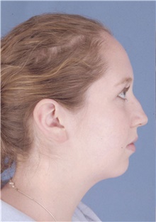 Rhinoplasty Before Photo by James Bradley, MD, FACS; Lake Success, NY - Case 46759