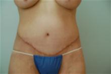 Body Contouring After Photo by Thomas Zewert, MD, PhD; Monterey, CA - Case 26817