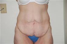 Body Contouring Before Photo by Thomas Zewert, MD, PhD; Monterey, CA - Case 26817