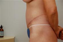 Body Contouring After Photo by Thomas Zewert, MD, PhD; Monterey, CA - Case 26817