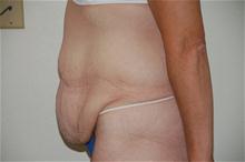 Body Contouring Before Photo by Thomas Zewert, MD, PhD; Monterey, CA - Case 26817